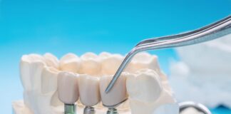 How Long Do Dental Implants Last? Dental Implants