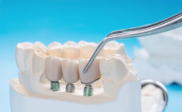 How Long Do Dental Implants Last? Dental Implants