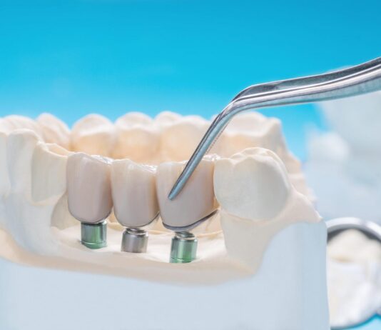 How Long Do Dental Implants Last? Dental Implants