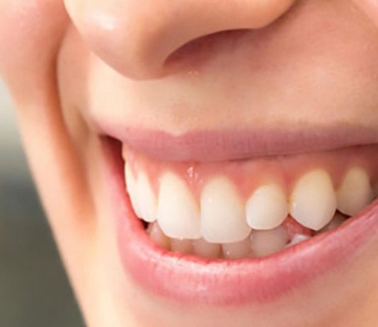 Tips On Combating Gum Recession Gum
